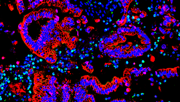 Bild zur Presseinformation "Wie das Immunsystem Bauchspeicheldrüsenkrebs beeinflusst: UMG-Forschungsgruppe entschlüsselt neue Mechanismen"